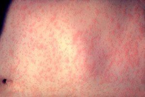 Measles infection (Wiki)