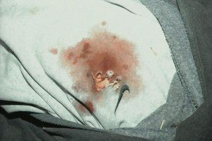 A close up of the entry wound of the bullet and the hole it made in Trayvon Martin's shirt