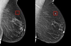 breast imaging cancer detection